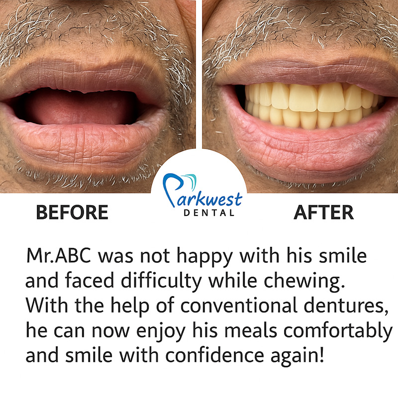 Park West Dental | Sleep Apnea, Dental Cleanings and Fluoride Treatment