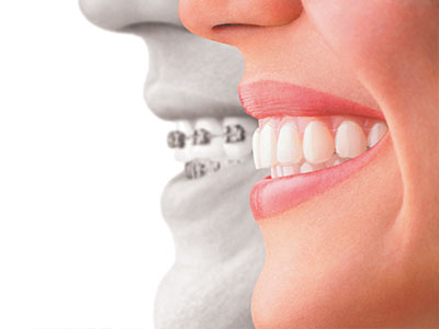 The image shows a composite of two people s faces with an overlay of a dental implant, suggesting the transformation from missing teeth to a complete smile.