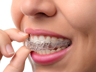 Woman brushing her teeth with a clear aligner.